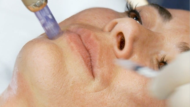 Dermica Goldpen microneedling